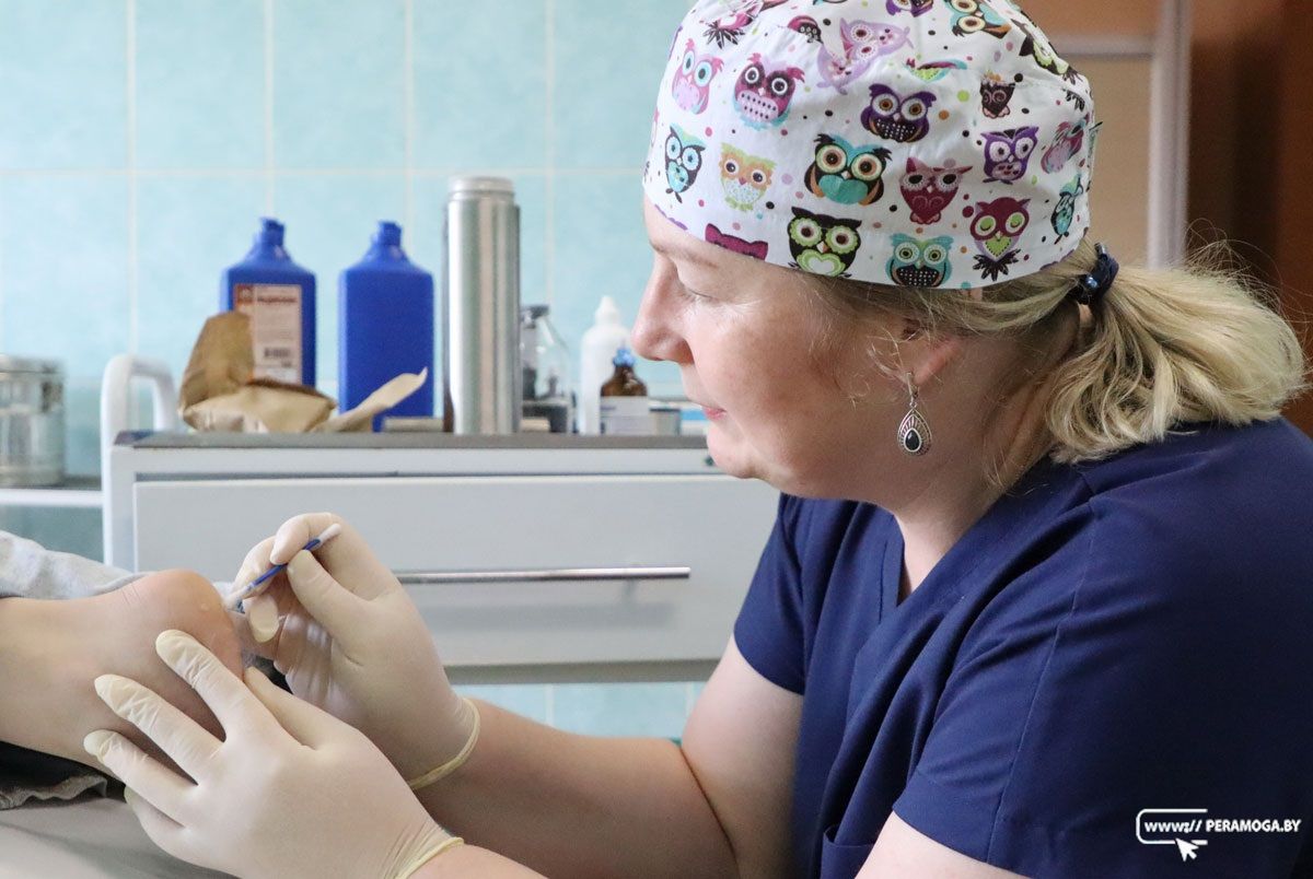 Удалить бородавку теперь можно в Вилейке – жидким азотом